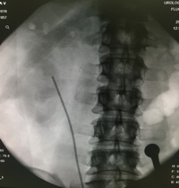 Рентгеногогические этапы операции 