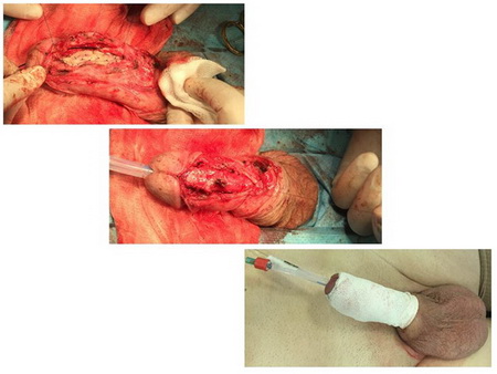 Операция буккальная пластика пенильного отдела уретры