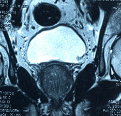 Магнитно резонансная томография органов малого таза