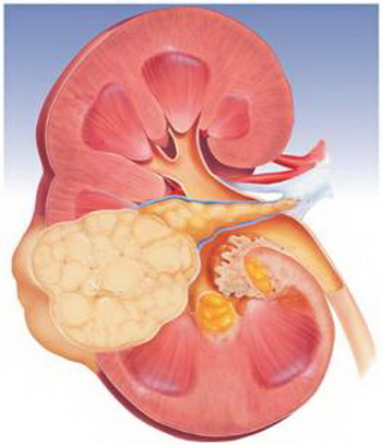 Лечение опухоли лоханки и мочеточника