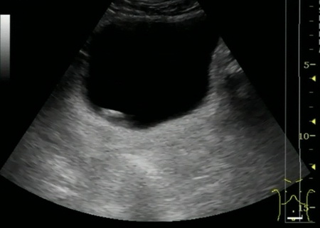 УЗИ мочевого пузыря