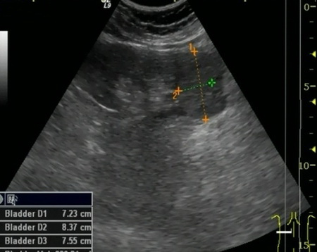 УЗИ левой почки