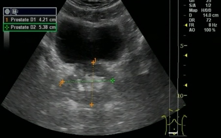 УЗИ мочевого пузыря и предстательной железы УЗИ мочевого пузыря и предстательной железы