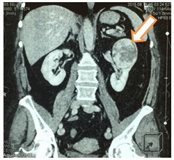 Результат МСКТ до операции