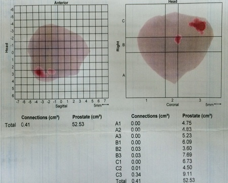 Гистосканирование предстательной железы
