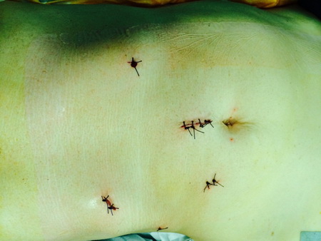 Пациент на операционном столе после окончания операции Пациент на операционном столе после окончания операции