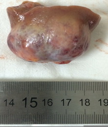 Опухоль после удаления