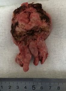 Удаленная предстательная железа 