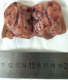 Опухоль после удаления на разрезе