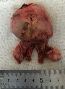 Удаленная предстательная железа с семенными пузырьками 