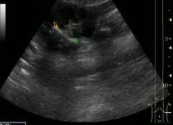 Коралловидный камень левой почки