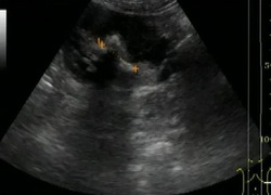 Мочекаменная болезнь