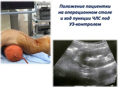 Положение пациентки на операционном столе