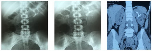 Обзорная рентгенография