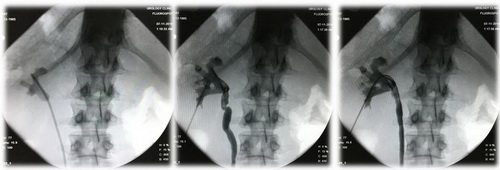 Рентгенологические этапы операции