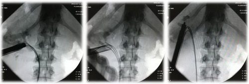 Этапы операции