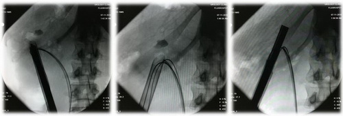 Рентгенологические этапы операции