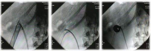 Этапы операции