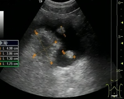 Рак мочевого пузыря