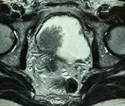 Трансуретральное удаление образований мочевого пузыря