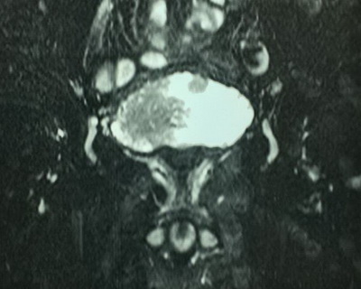 Лазерная en-bloc резекция мочевого пузыря