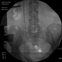 Рентгеноскопические этапы операции