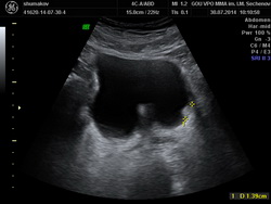 УЗИ мочевого пузыря