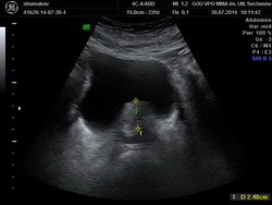 УЗИ предстательной железы