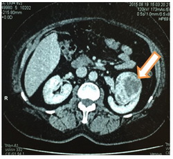 Результат МСКТ