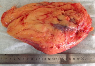 Почечно-клеточный рак