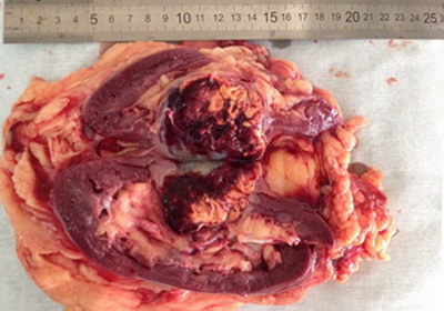 Почечно-клеточный рак