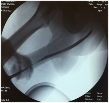 Стриктура мочеиспускательного канала