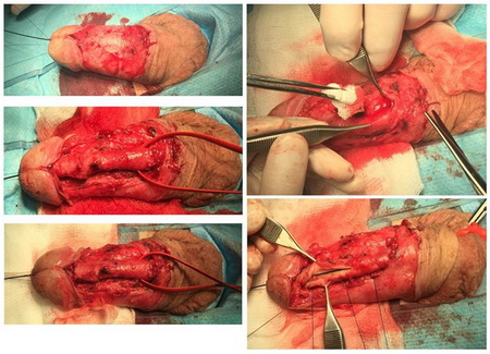 Буккальная пластика пенильного отдела уретры