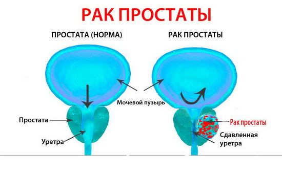 Рак предстательной железы презентация