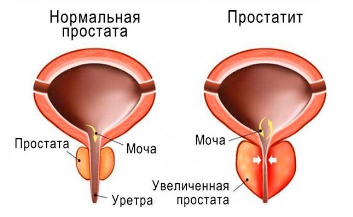 Способы лечения аденомы простаты без операции