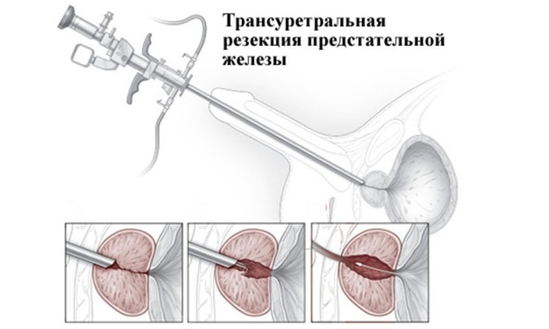 Rezecția transuretrală (RTU) pentru adenom de prostată | Proceduri medicale