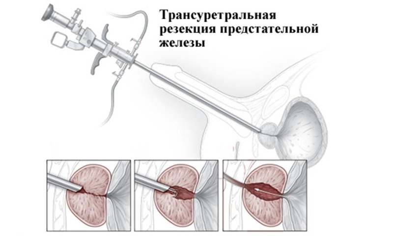 Удаление опухоли с паращитовидных желез при первичном и вторичном гиперпаратиреозе