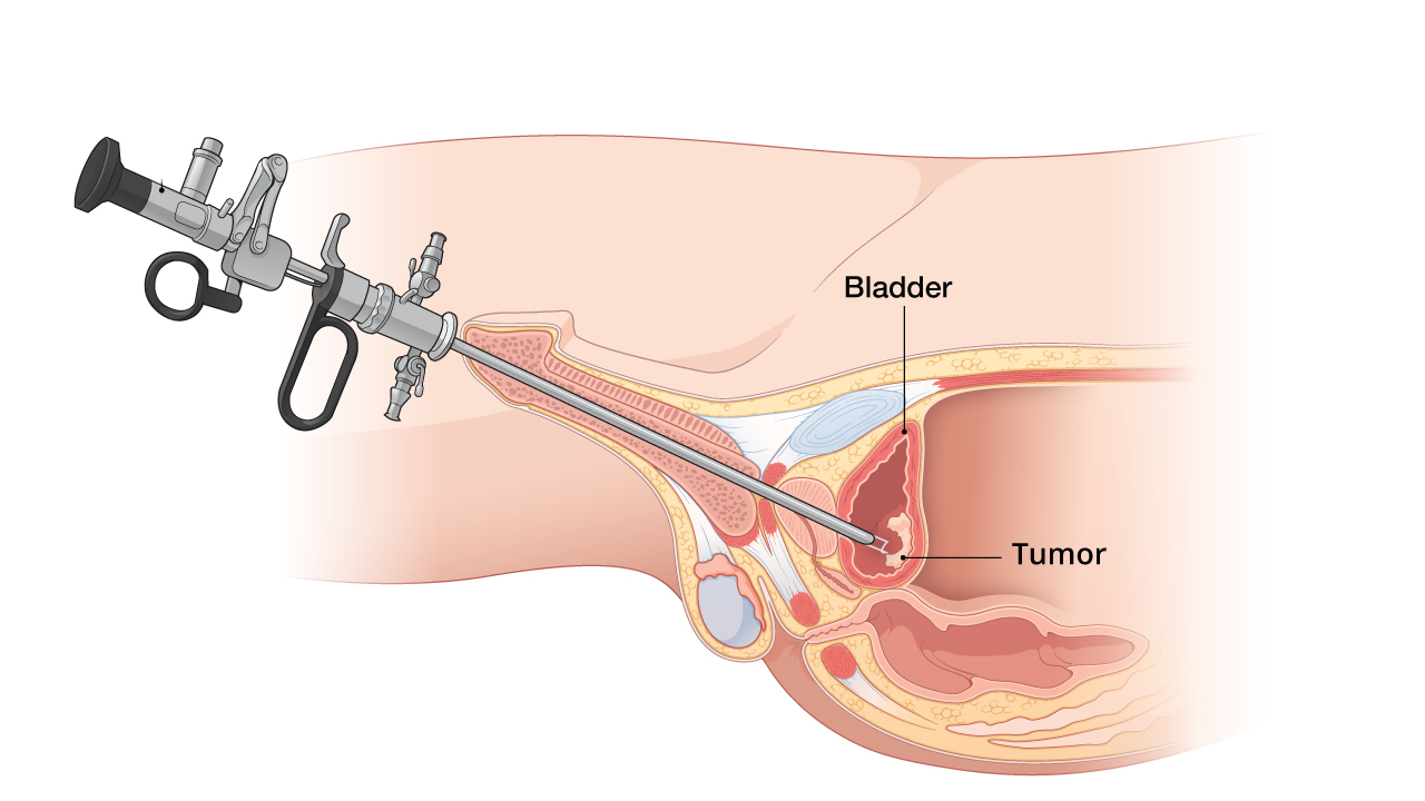 Риски и последствия ТУР мочевого пузыря: что ожидать после операции