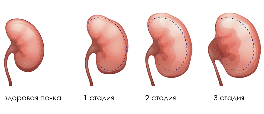 Заболевания почек: симптомы, признаки, лечение болезней почек | Статьи МЕДСИ