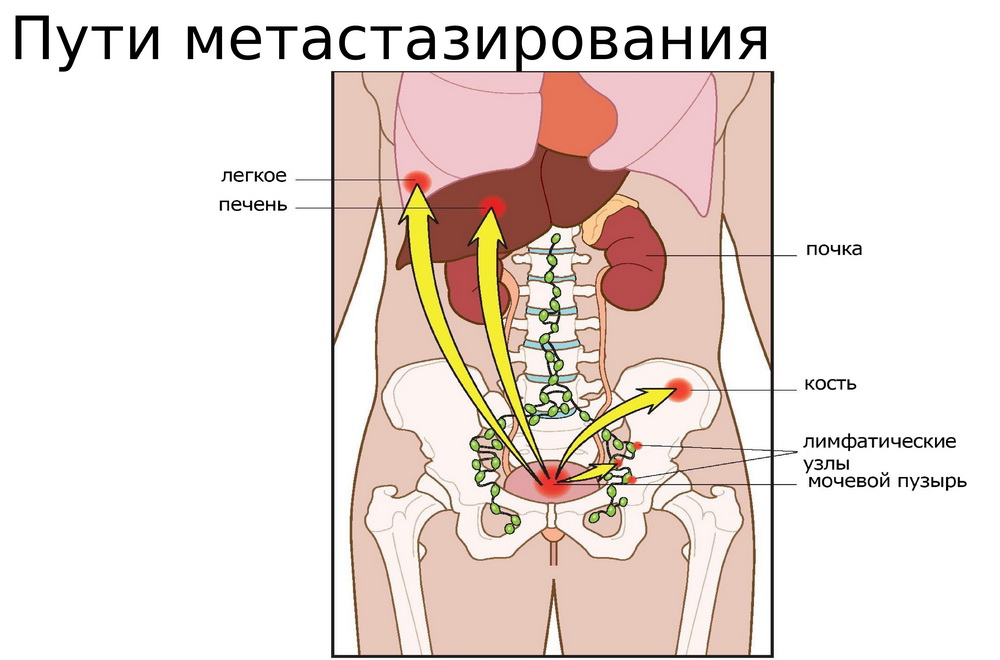 Метастазы в костях