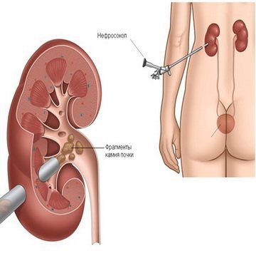 Чрескожная перкутанная нефролитотрипсия — операция по удалению камней в почках