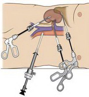 Лапароскопическая нефрэктомия в государственной клинике — удаление почки с минимальным риском