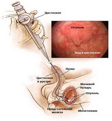 Трансуретральная резекция мочевого пузыря при опухоли