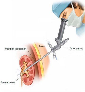 Чрескожная нефролитотрипсия: современное решение проблем с камнями в почках