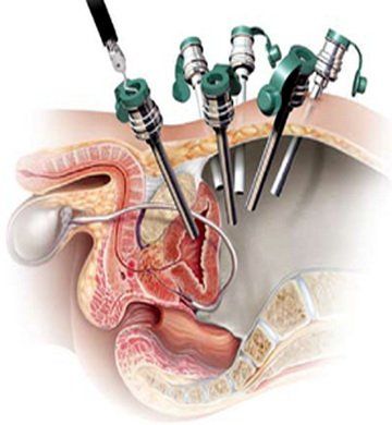 Лапароскопическая нервосберегающая простатэктомия — минимально инвазивное лечение рака простаты