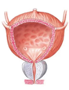 Последствия ТУР мочевого пузыря: краткосрочные и долгосрочные осложнения