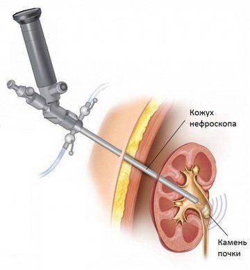 Миниперкутанная нефролитотомия в Москве — лечение камней в почках через прокол