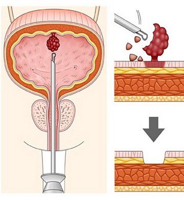 Трансуретральная электрорезекция стенки мочевого пузыря с опухолью и гиперплазии простаты