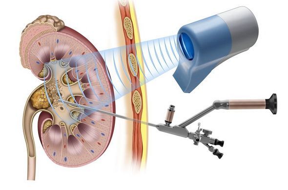 Лазерная операция на почках: современное решение проблемы камней в почках