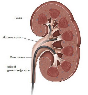 Контактная уретеролитотрипсия и ретроградная нефролитотрипсия — помощь при камнях в мочеточнике
